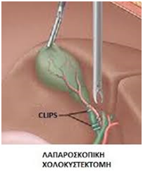 χολολιθίαση - αντιμετωπιση - ΚΟΥΖΑΝΙΔΗΣ ΝΙΚΟΛΑΟΣ MD, MSc ΓΕΝΙΚΟΣ ΧΕΙΡΟΥΡΓΟΣ
